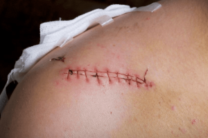 Compensation for scarring claims guide 